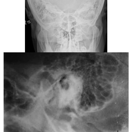 X-Ray Mastoids Lateral Oblique & Townes View